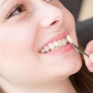 Dental Veneers in Dubai | Dubai Cosmetic Surgery Clinic