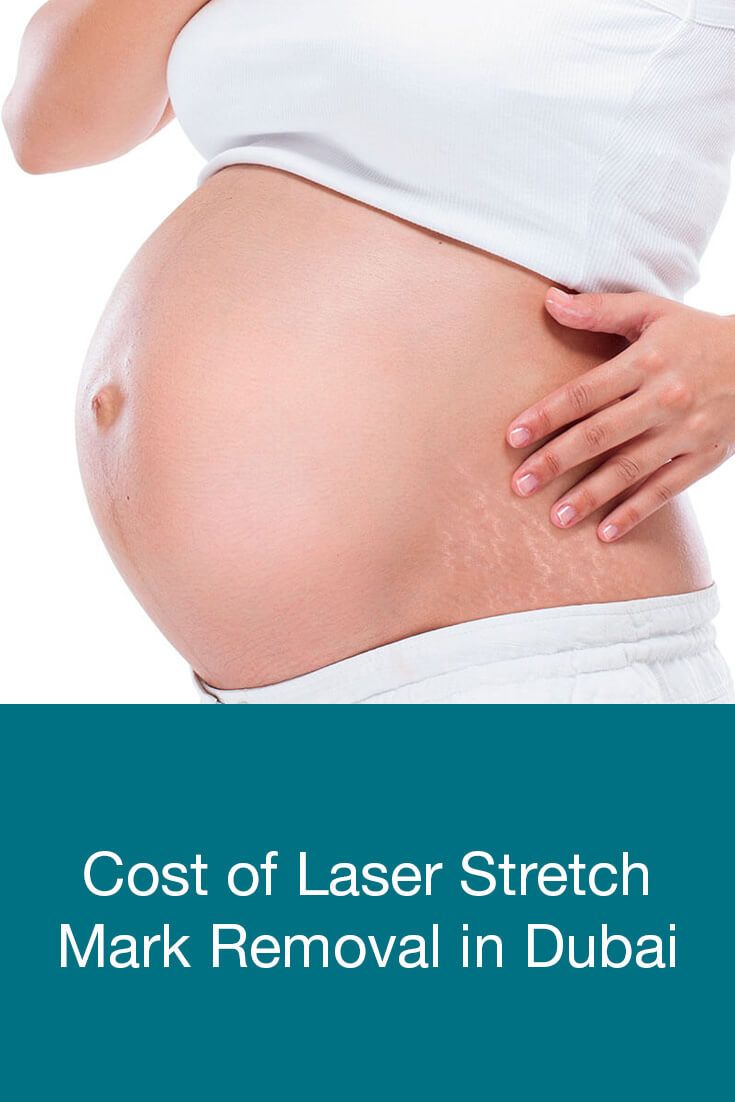 cost-of-laser-stretch-mark-removal-in-dubai-dubai-cosmetic-surgery