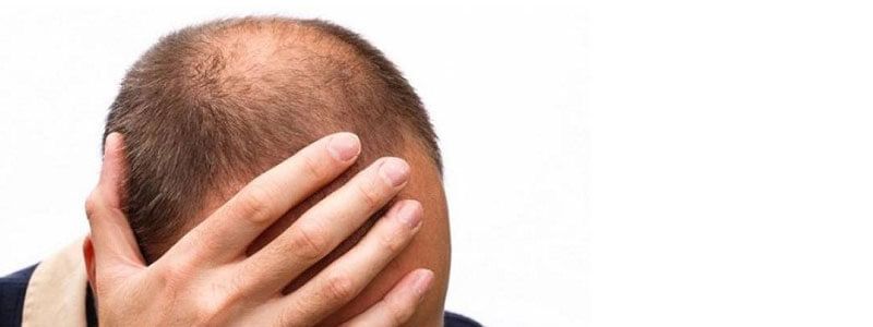 Success Rate Of Different Hair Transplant Types Dubai Cosmetic