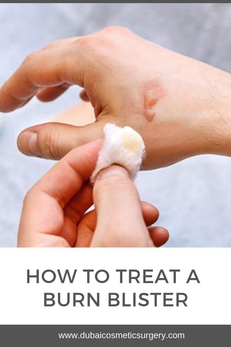 How to Treat a Burn Blister? Dubai Cosmetic Surgery®